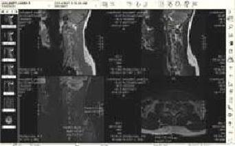 RFID Forced brain implant MRI